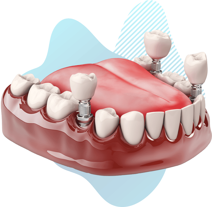 https://gebzecapadis.com/wp-content/uploads/2023/06/dental-implant-model-pasang.png