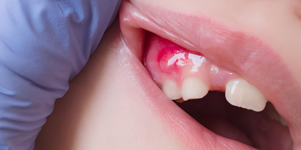 Causes and Treatment Methods of Dental Abscess