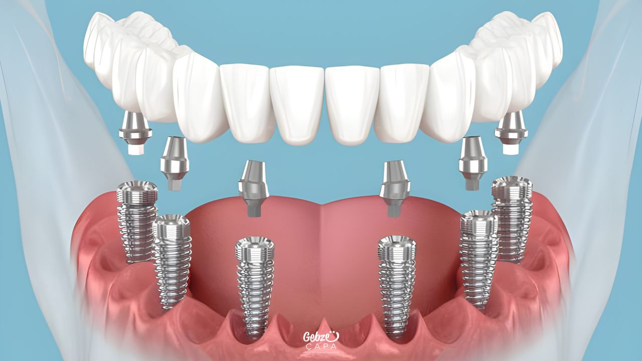 Implant-Supported Prosthesis - Gebze Çapa Ağız ve Diş Sağlığı Polikliniği