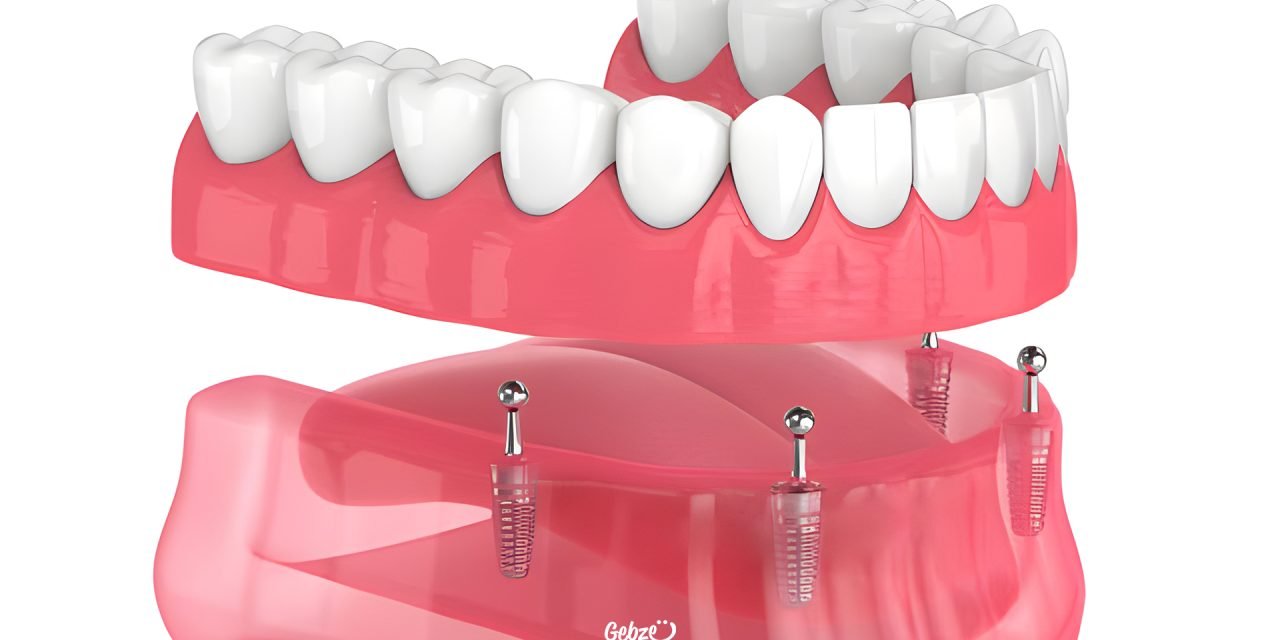 Implant-Supported Prosthesis