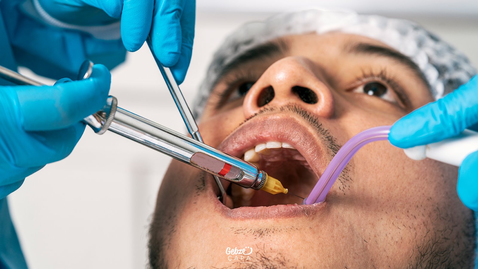 1 Diş Kanal Tedavisi Ne Kadar Sürer