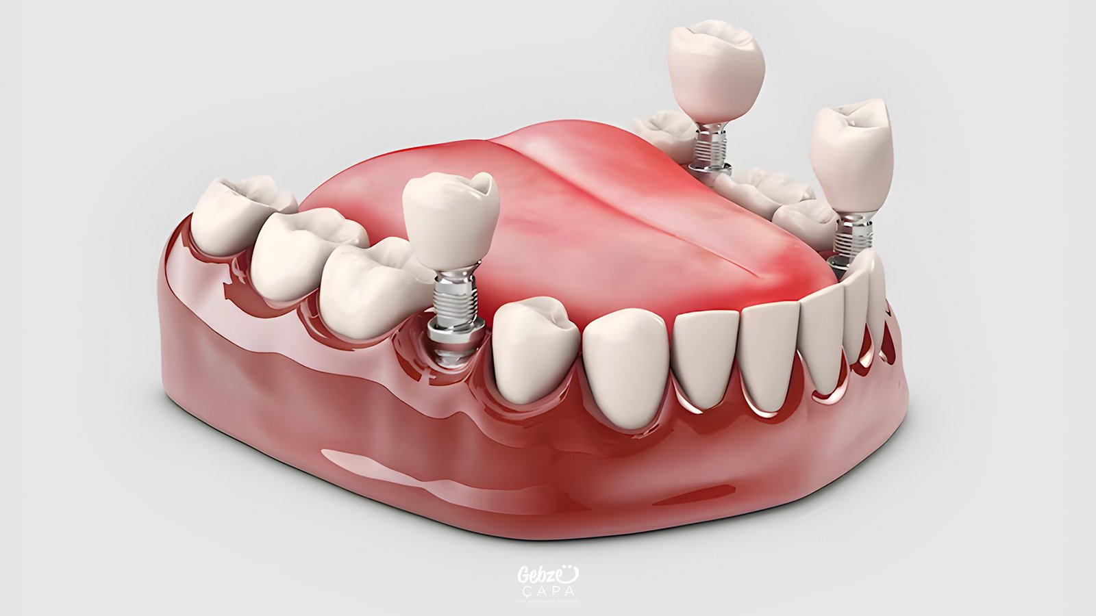 Post-Implant Oral Care