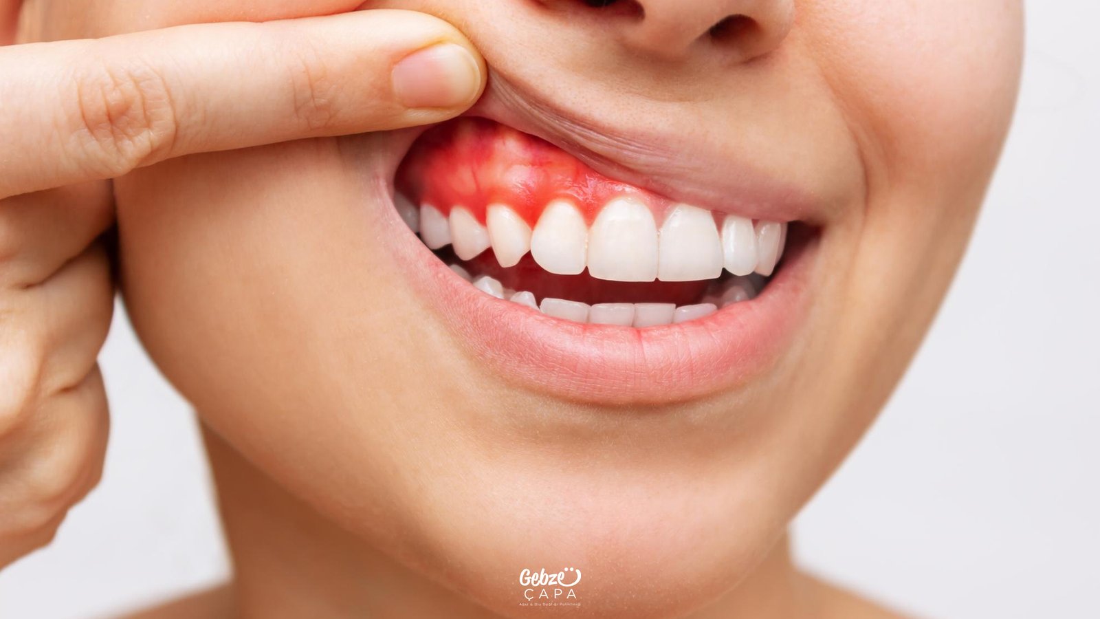 Persistent Gum Inflammation