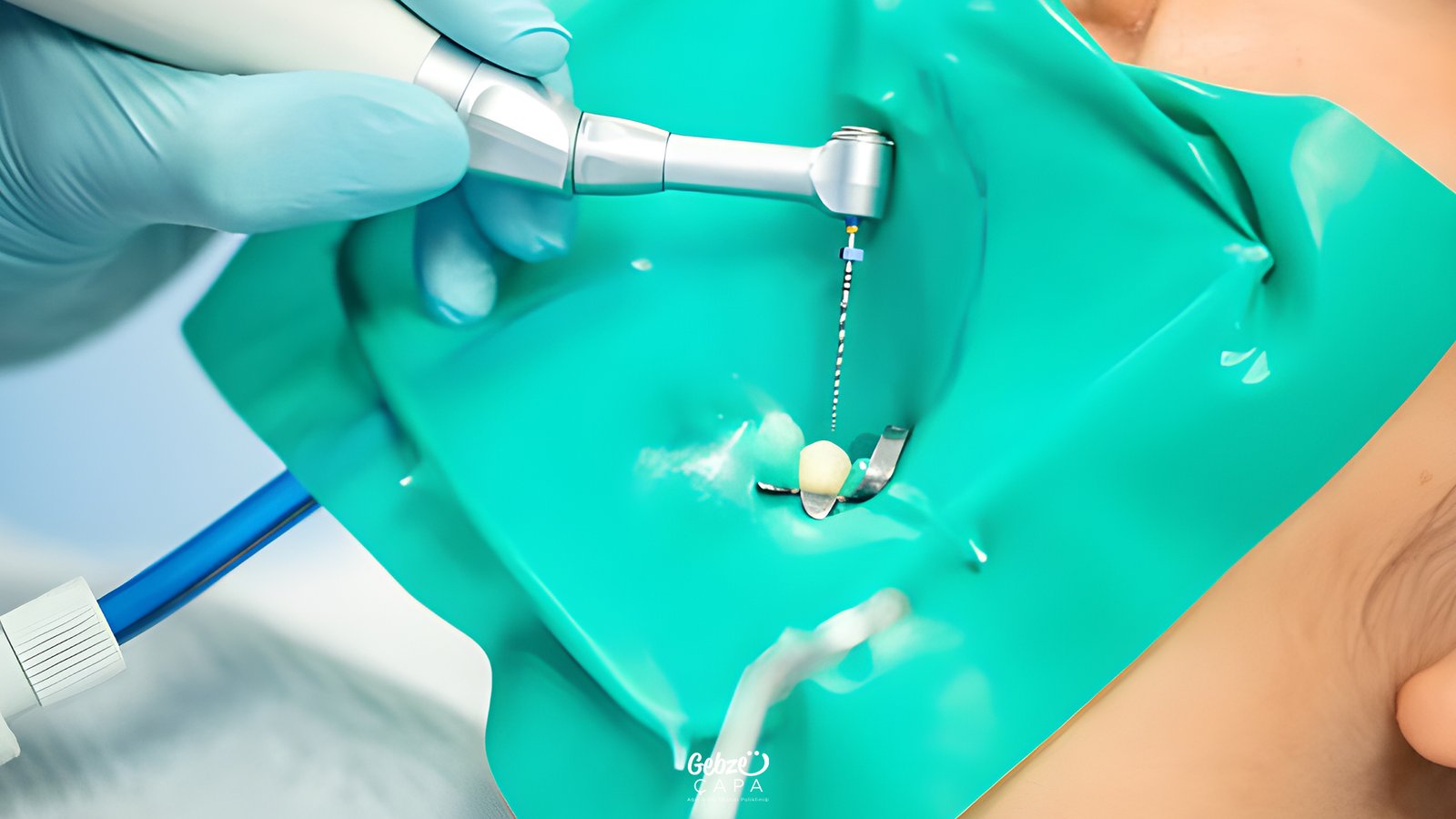 Root Canal Treatment Steps