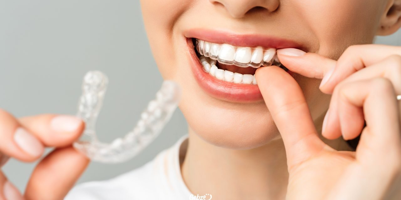 What is Invisalign?