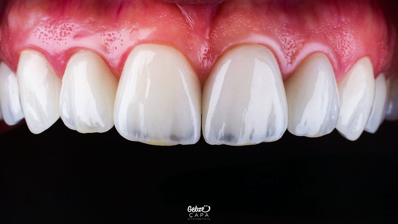 Zirconium Dental Crown