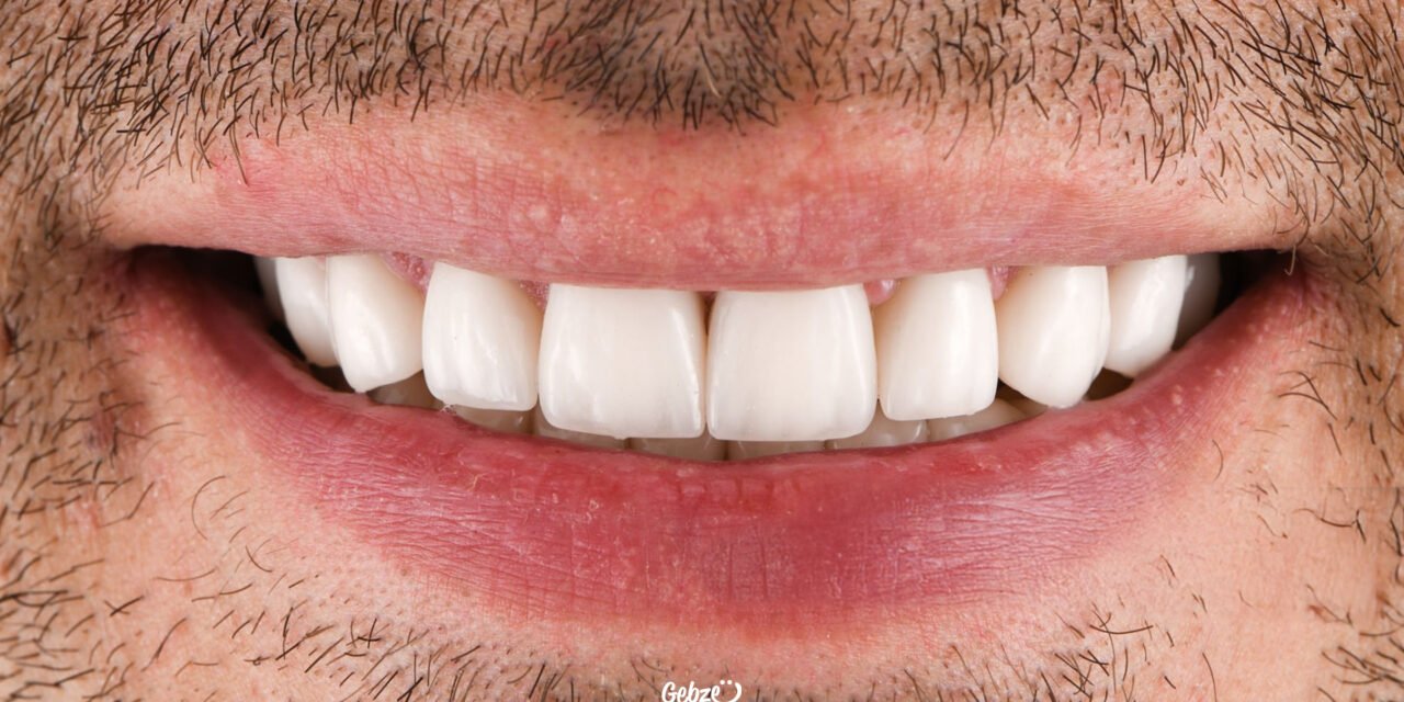 Zirconium Dental Crown