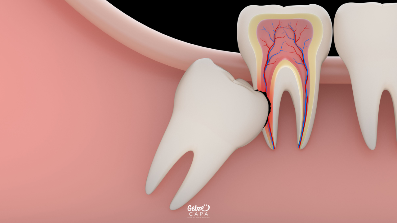 Impacted Tooth Extraction