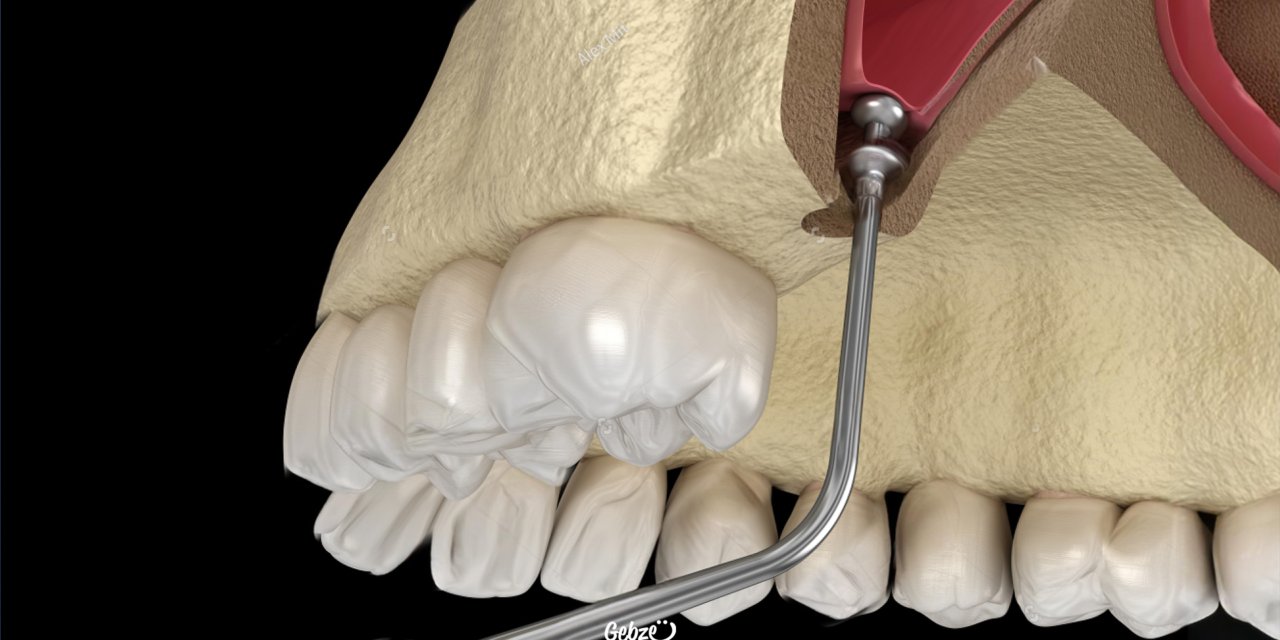 What is Sinus Lifting