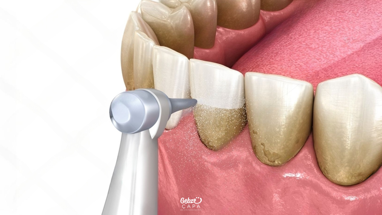 Dental Stone Cleaning