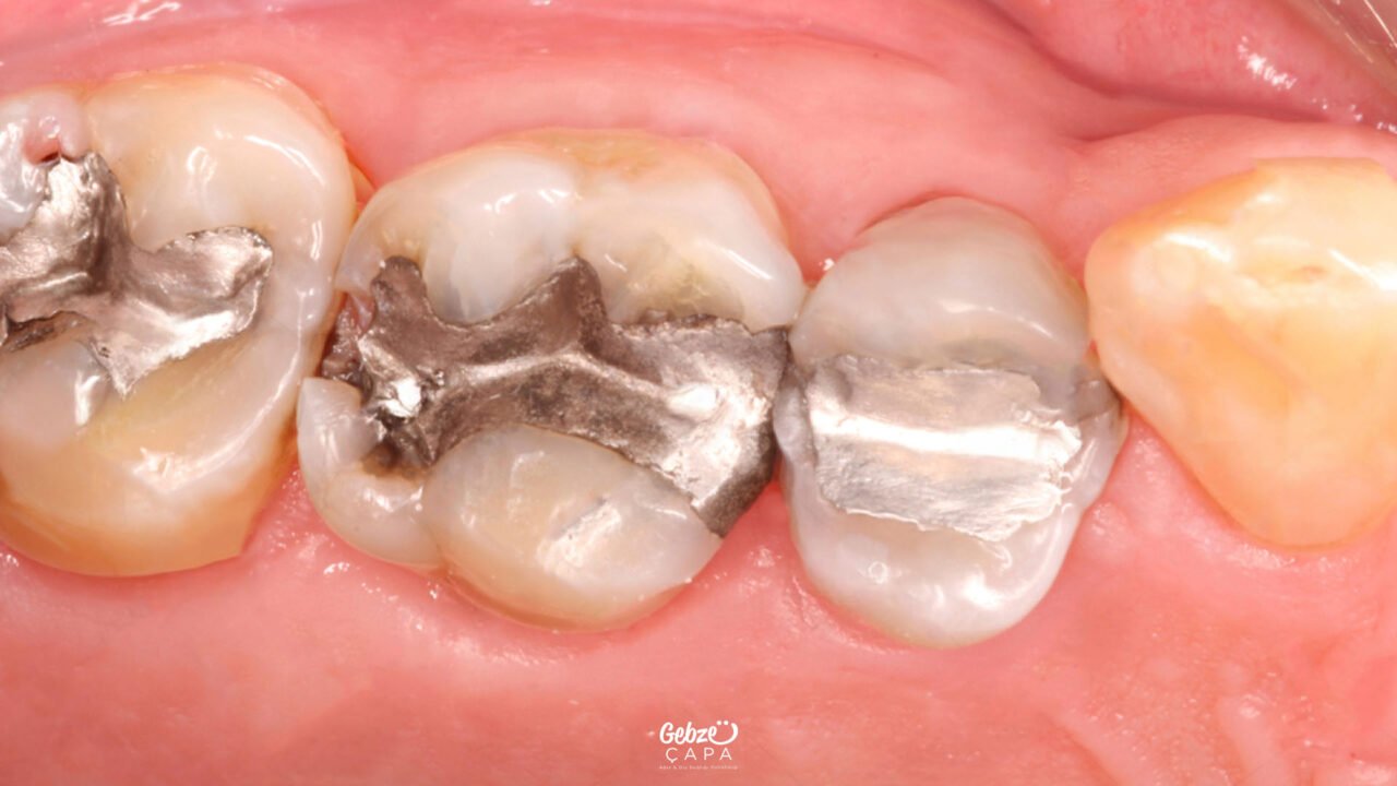 What is Amalgam Filling