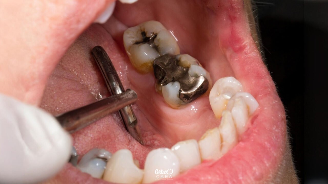 What is Amalgam Filling