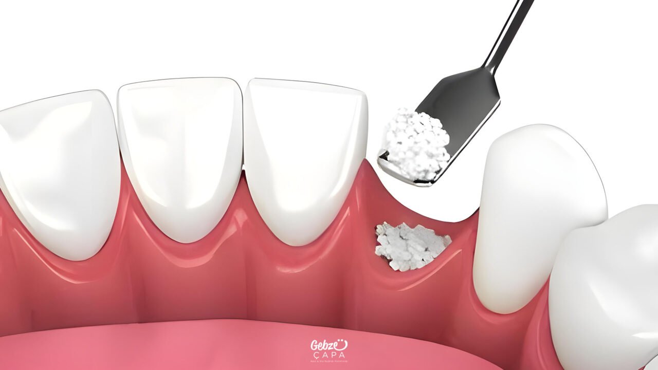 Bone Powder Surgery