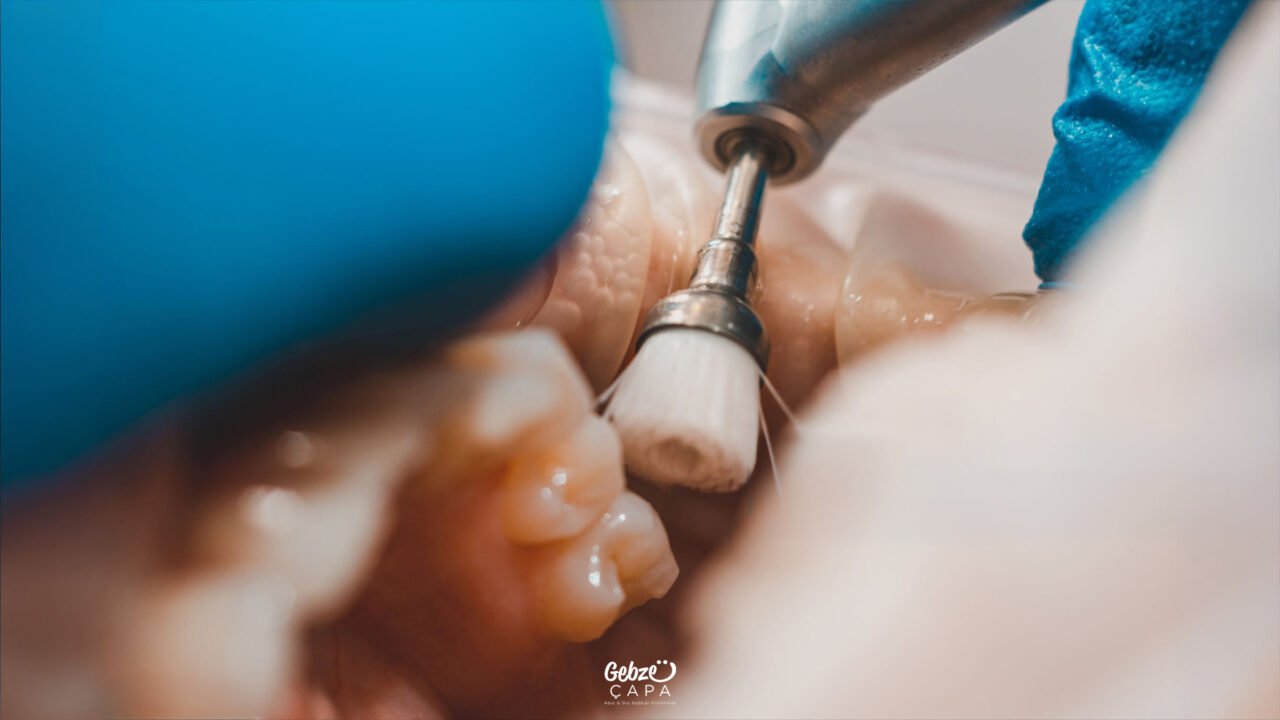 What is Dental Tartar Cleaning