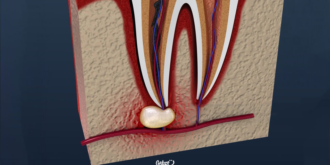 Apikal Rezeksiyon Nedir?