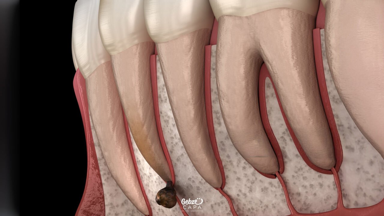 Apical Resection