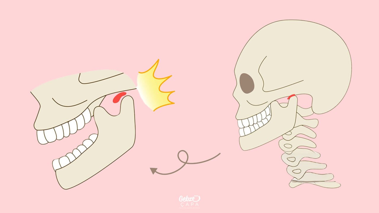 Jaw Mass