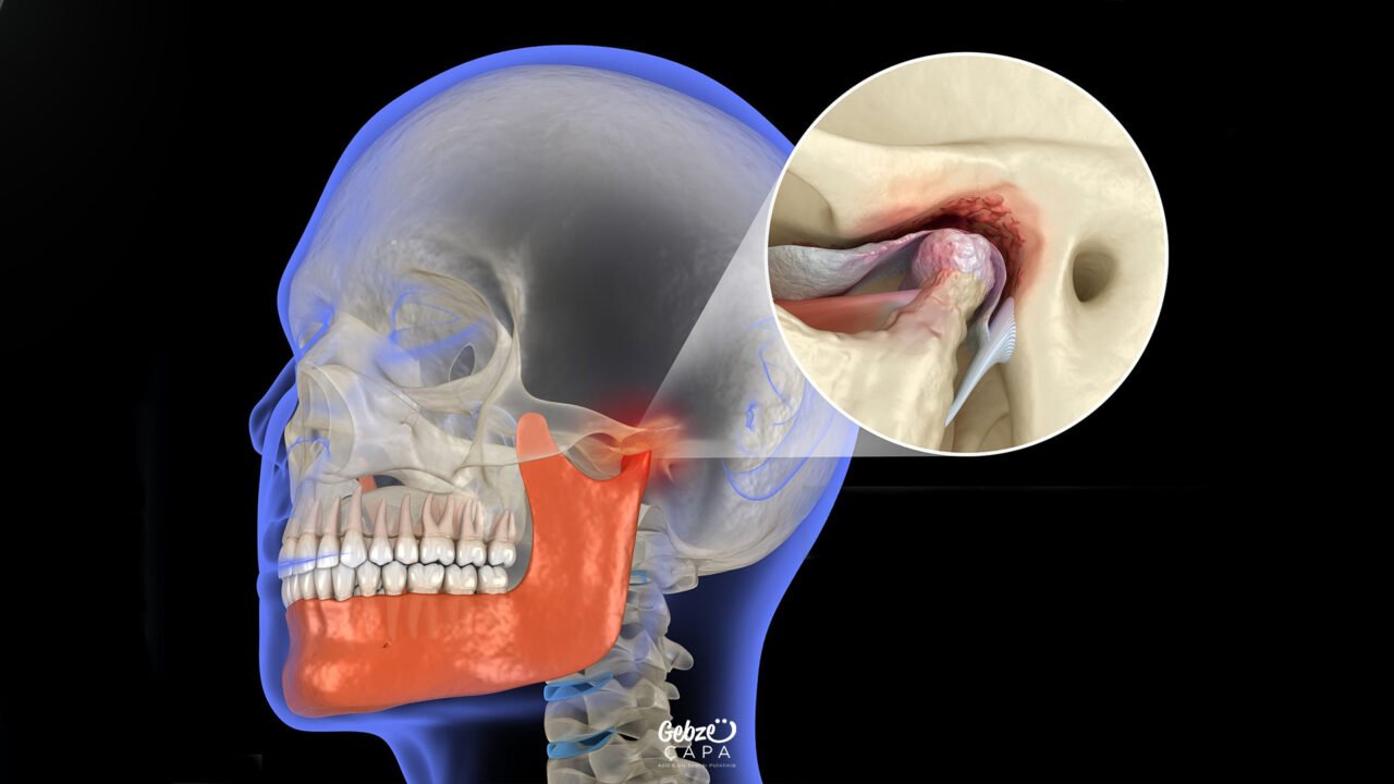 Jaw Mass