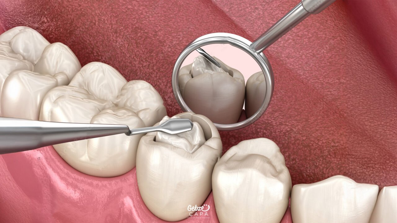 Do Filled Teeth Decay
