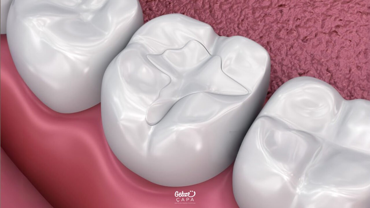 Do Filled Teeth Decay