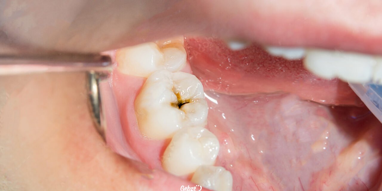 Dolgu Yapılan Diş Çürür Mü?