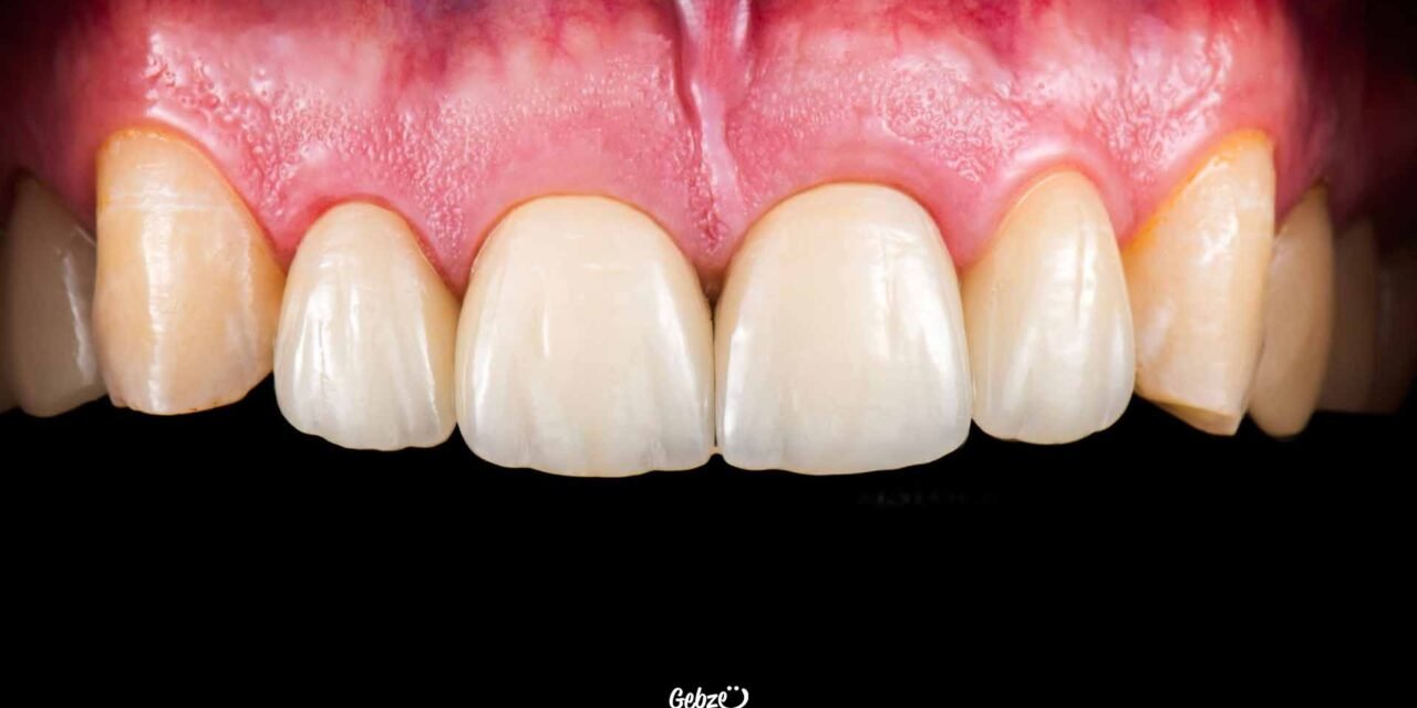 Diş Sararması Neden Olur?