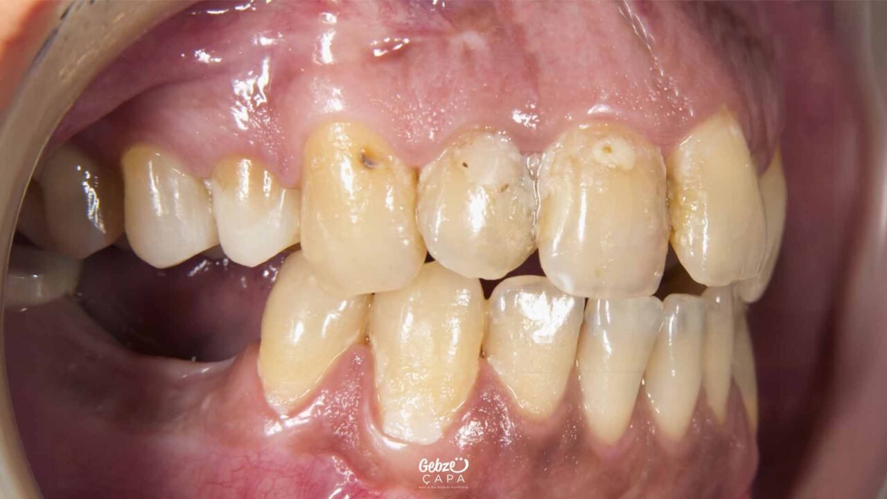What Causes Yellowing of Teeth