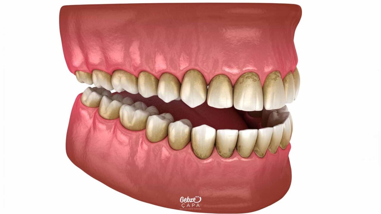 What Causes Yellowing of Teeth