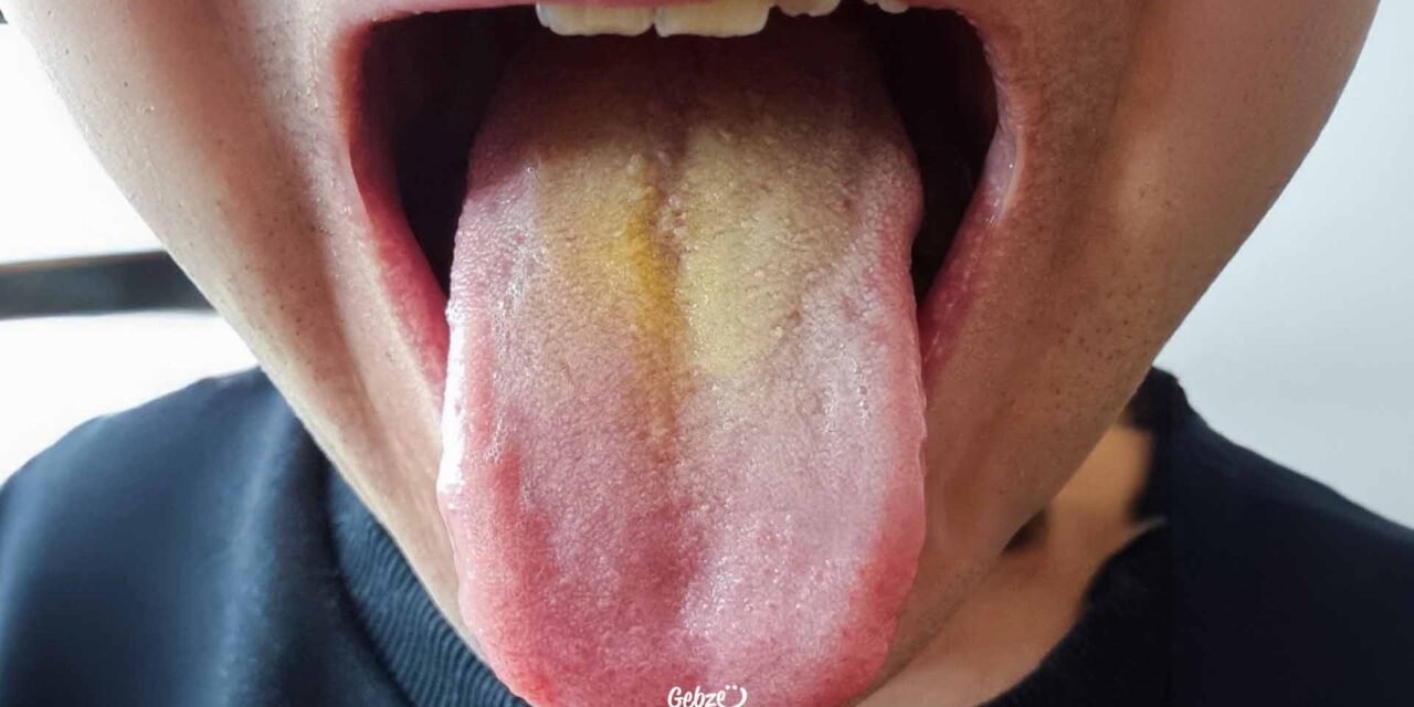 Dilimiz Neden Sararır?