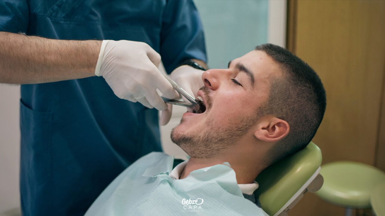When is an Implant Used to Replace an Extracted Tooth