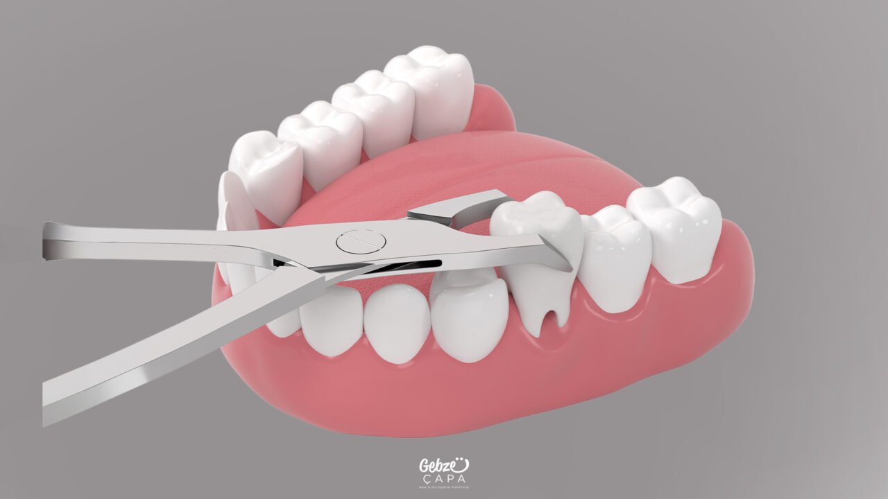 When is an Implant Used to Replace an Extracted Tooth