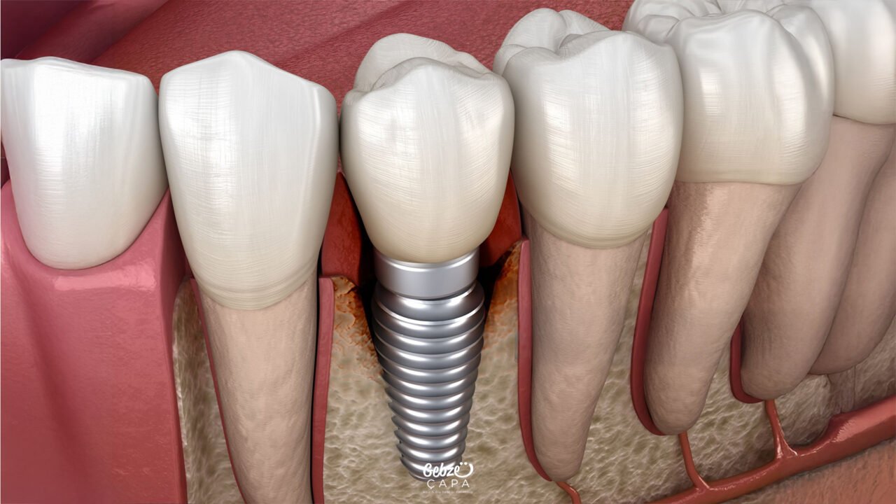 When is an Implant Used to Replace an Extracted Tooth