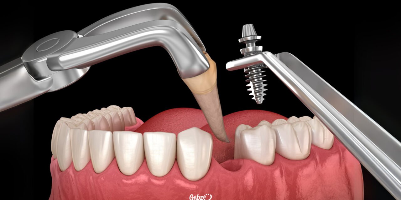 Çekilen Dişin Yerine Ne Zaman İmplant Yapılır?