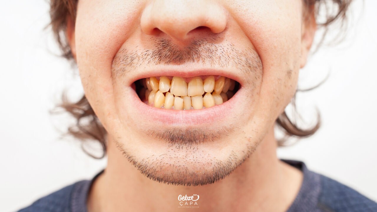 What Causes Yellowing of Teeth