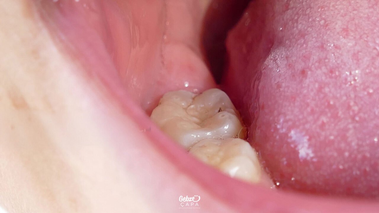 Can Root Canal Treatment Be Performed on Wisdom Tooth
