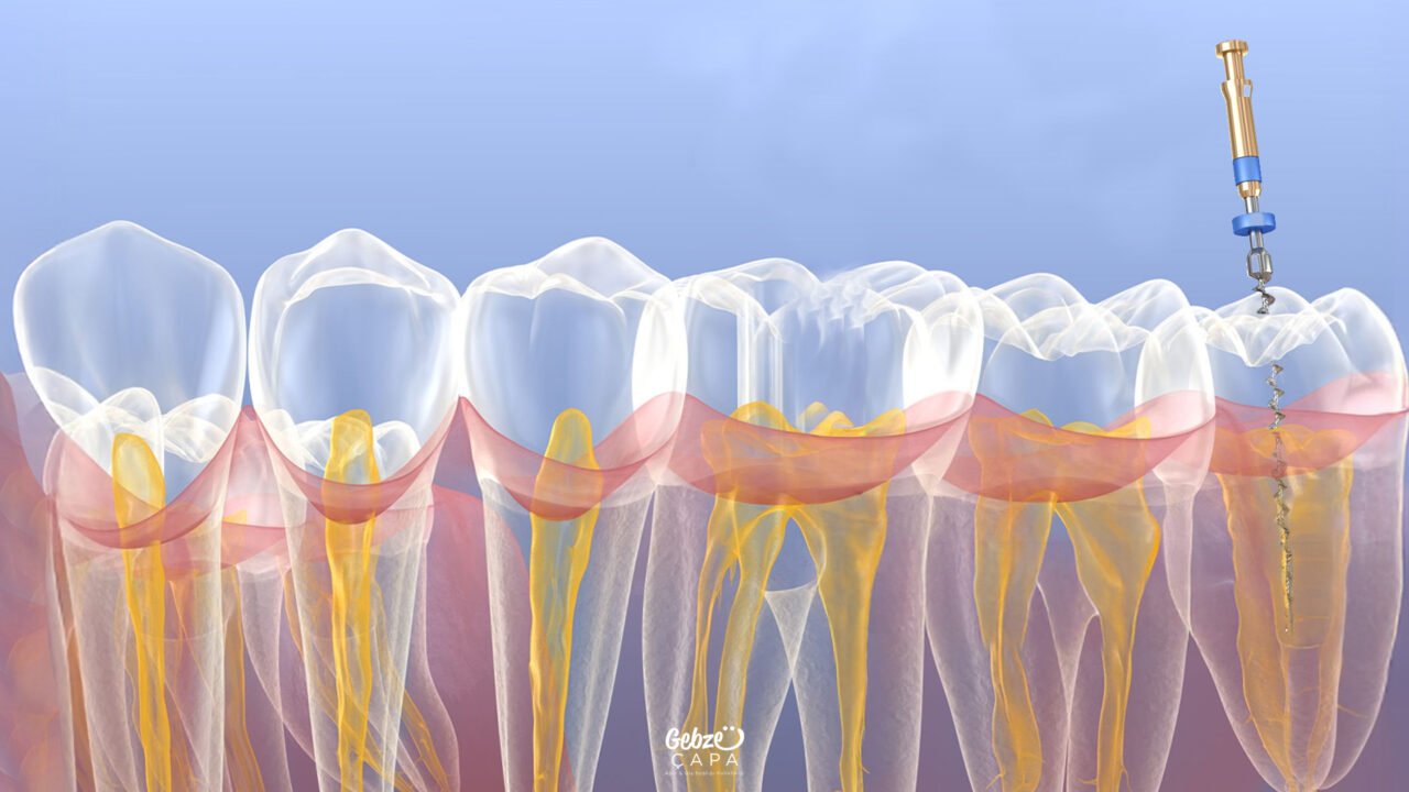 Can Root Canal Treatment Be Performed on Wisdom Tooth