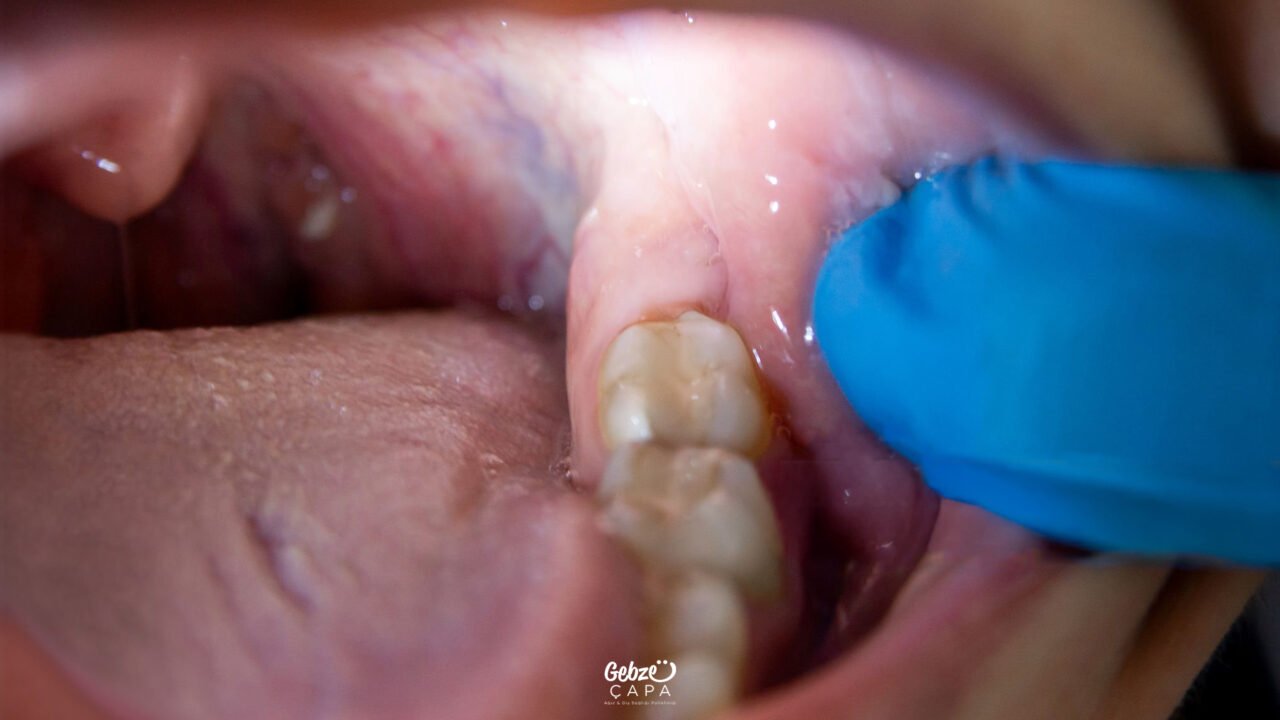 Can Root Canal Treatment Be Performed on Wisdom Tooth