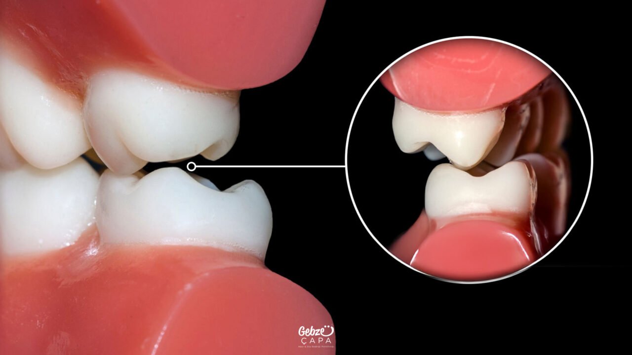 What is Malocclusion 