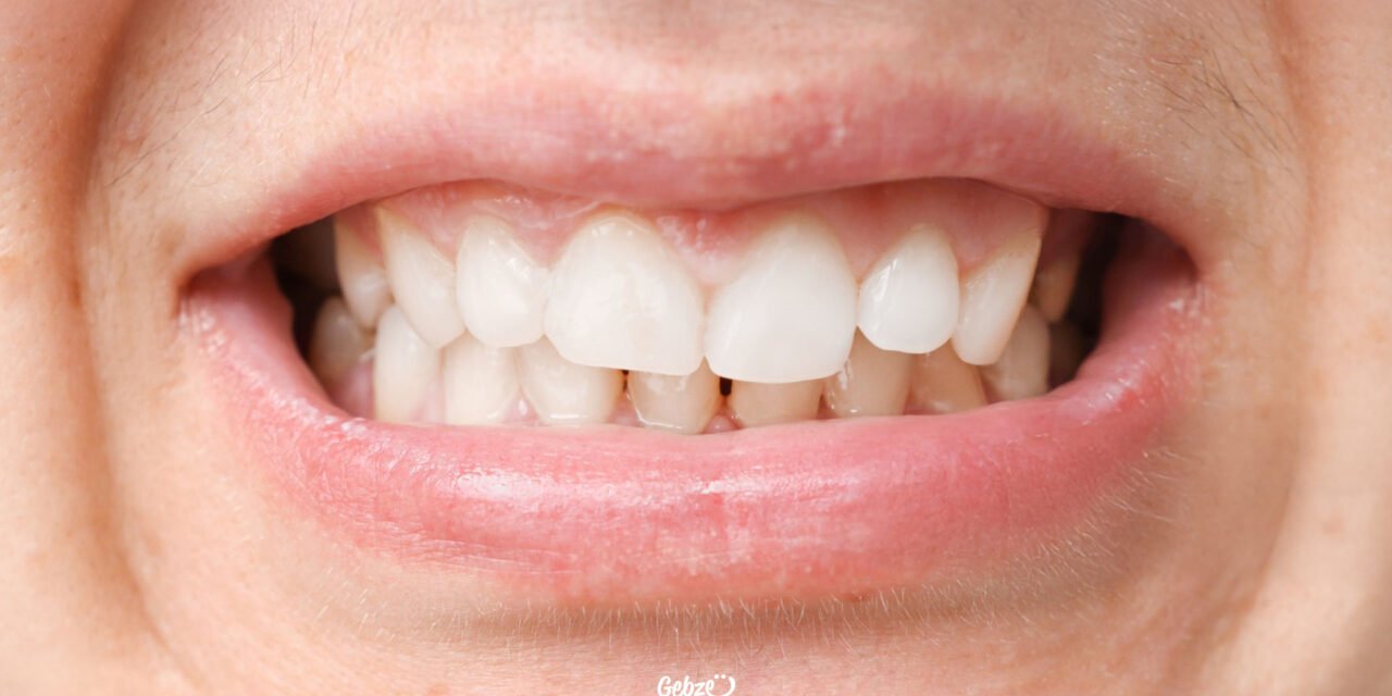 Kapanış Bozukluğu Nedir, Nasıl Tedavi Edilir?