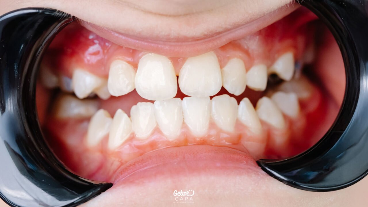 What is Malocclusion 