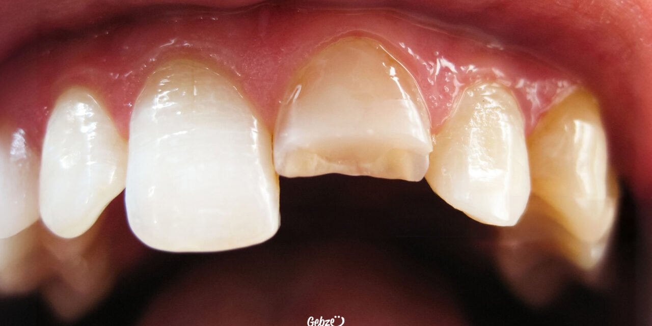 Kırık Diş Tedavisi Nasıl Yapılır?