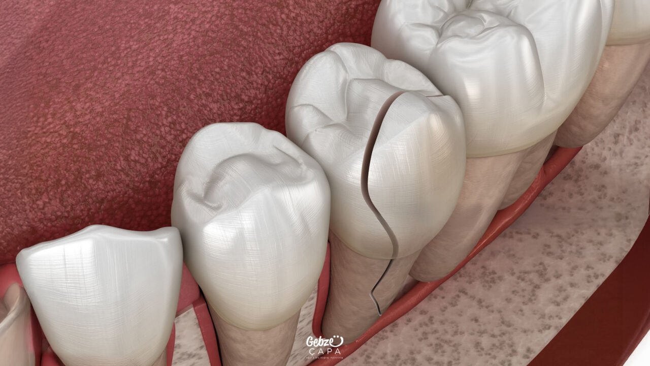 Broken Tooth