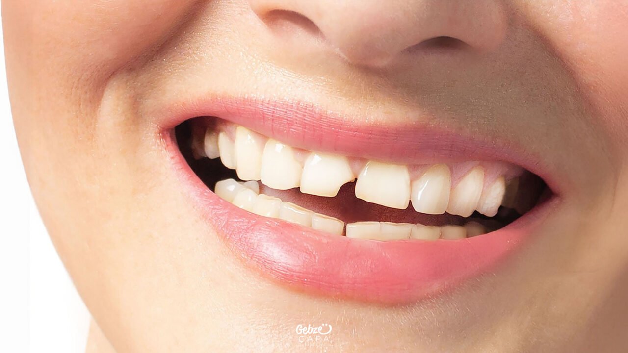 Broken Tooth