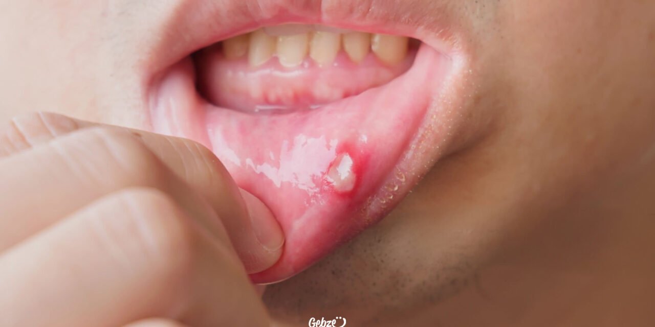 Ağız Yarası Nedir? Ağız Yarası Nasıl Geçer?