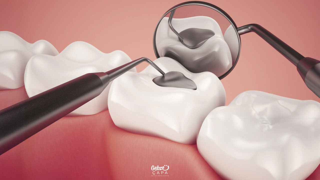 Types of Dental Fillings