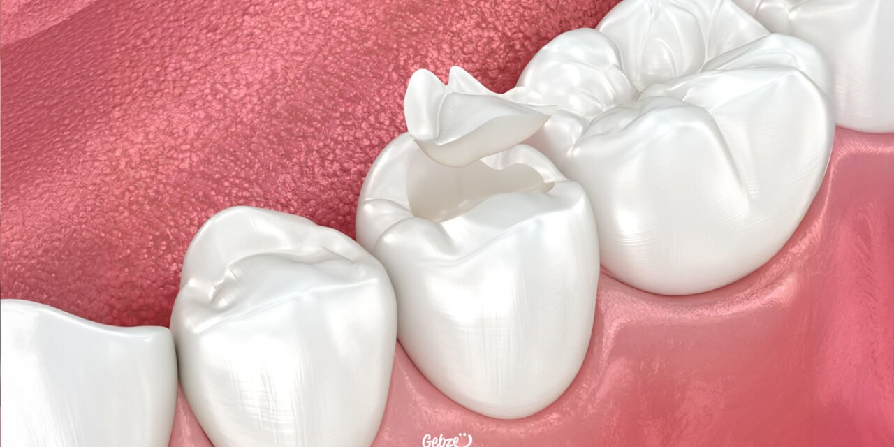Diş Dolgusu Çeşitleri