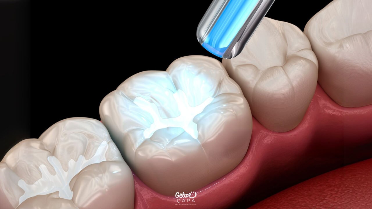 fissure sealant