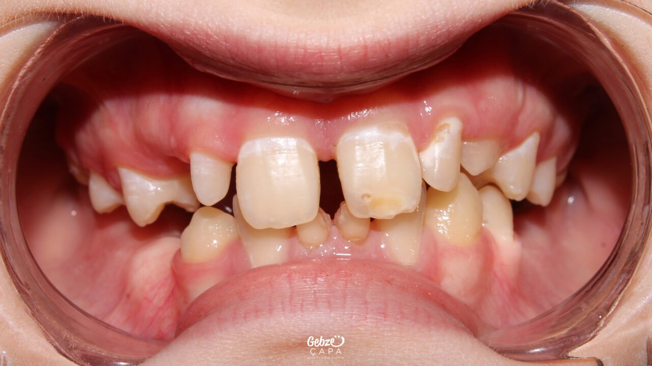 Crooked Teeth Treatment