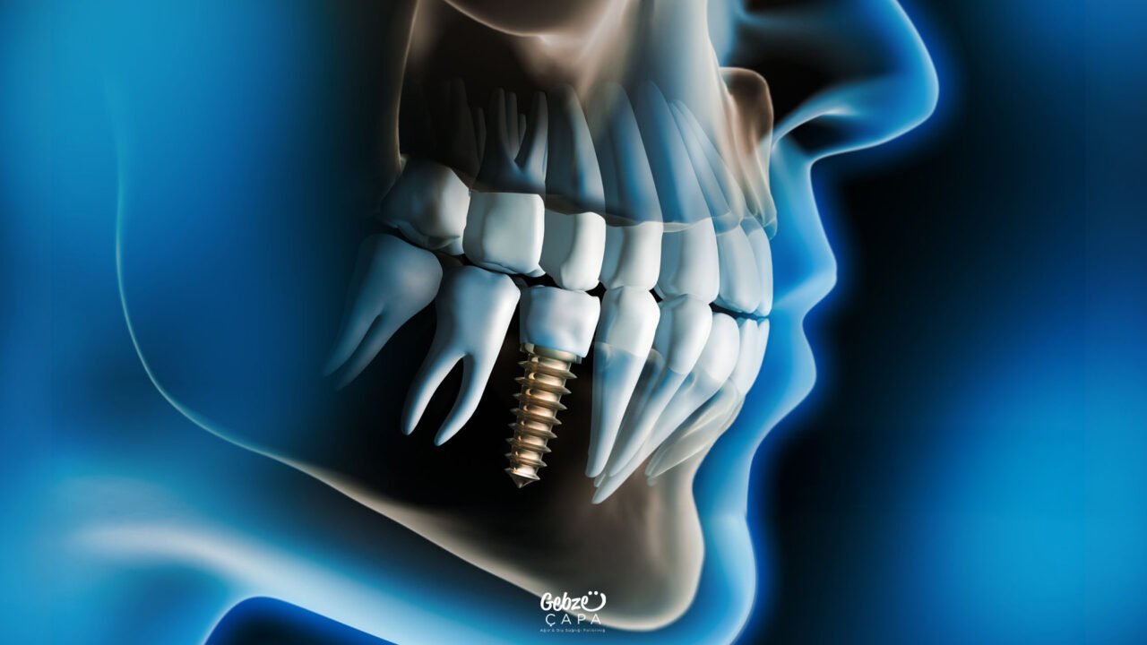 Can a Person with an Implant Have an MRI