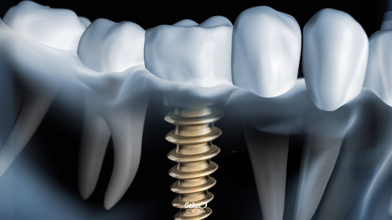 Can a Person with an Implant Have an MRI